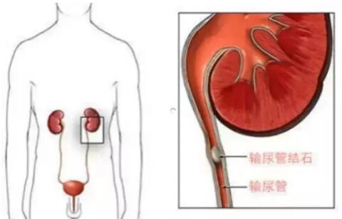 輸尿管結石，到底能不能保守治療？