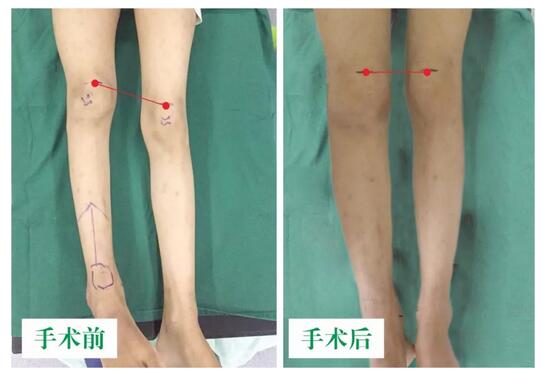 女孩墜梯右腿縮短5cm，幸得醫生及時診治恢復正常腿型