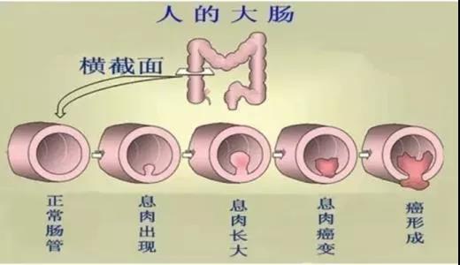 體檢發現腸息肉會癌變嗎？